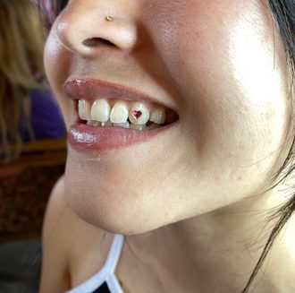 Tooth Gems, Sonrisa Bling